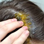 BUBULJICE NA GLAVI SU SVE ČEŠĆI PROBLEM: Ni slučajno ih ne istiskujte, evo zašto se javljaju I ŠTA TREBATE URADITI DA NESTANU BUBULJICE NA GLAVI SU SVE ČEŠĆI PROBLEM: Ni slučajno ih ne istiskujte, evo zašto se javljaju I ŠTA TREBATE URADITI DA NESTANU - featured image