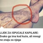 Svatko kod kuće ima lijek za popucale kapilare, ali mnogi ljudi to ne znaju! Svatko kod kuće ima lijek za popucale kapilare, ali mnogi ljudi to ne znaju! - featured image