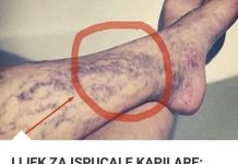 Svatko kod kuće ima lijek za popucale kapilare, ali mnogi ljudi to ne znaju! Svatko kod kuće ima lijek za popucale kapilare, ali mnogi ljudi to ne znaju! - featured image