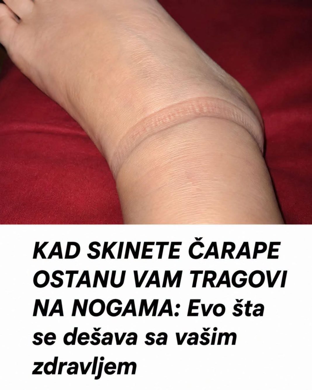 KAD SKINETE ČARAPE OSTANU VAM TRAGOVI NA NOGAMA: Evo šta se dešava sa vašim zdravljem - featured image KAD SKINETE ČARAPE OSTANU VAM TRAGOVI NA NOGAMA: Evo šta se dešava sa vašim zdravljem - featured image